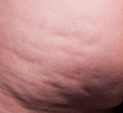 Cellfina™ à Paris: le CLIPP premier centre à avoir utiliser cette technique.