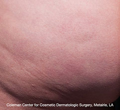 Cellfina™ des résultats durables et visibles 3 ans après.