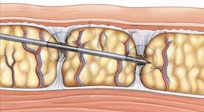 Gommer les capitons avec CELLFINA.