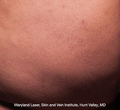 Cellfina™ la plus grande expertise à Paris et en France au CLIPP.