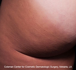 Cellfina™ des résultats prouvés, des avis unanimes, au CLIPP à Paris.