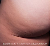 Cellfina: gommer les capitons et la cellulite durablement, au CLIPP à Paris.