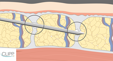 Cellulite: Cellfina est un traitement anti-capitons, au clipp à Paris et en France.