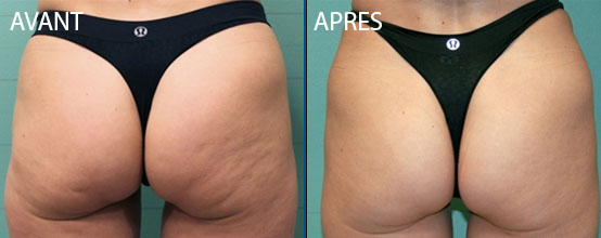 fesses avant après 1