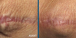 avant aprés laser fraxel 3