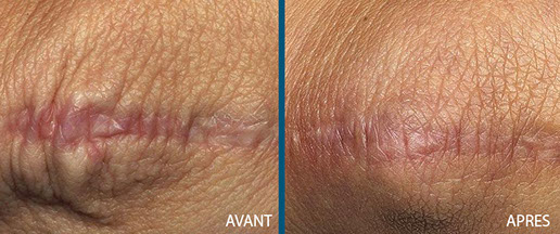 avant aprés laser fraxel 3