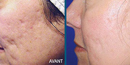 avant aprés laser fraxel