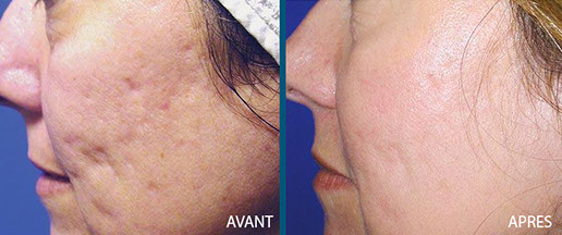 avant après laser fraxel repair 10