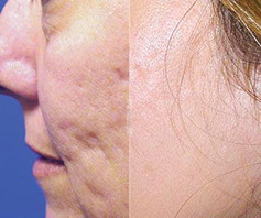 Effacer les cicatrices d'acné grâce au laser et à l'expertise des médecins du CLIPP à Paris.