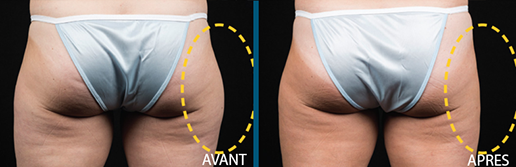 cryolipolyse à paris, résultats avant et après.