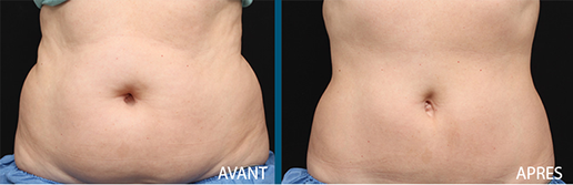 avant après cryolipolyse zeltiq centre laser clipp paris