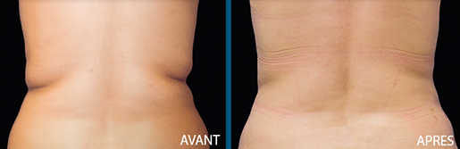 avant après cryolipolyse zeltiq centre laser clipp paris 2