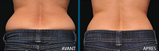 avant après cryolipolyse zeltiq centre laser clipp paris 9