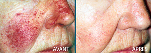 avant après laser vbeam perfecta centre laser clipp paris