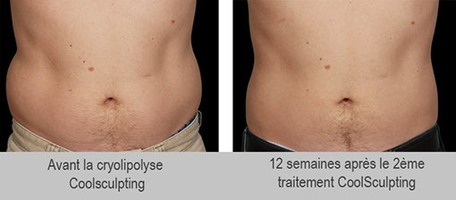 Résultats et avis de la cryolipolyse chez l'homme ou les hommes à paris. Coolscultping à paris