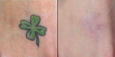 avant après detatouage 1