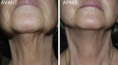 E matrix: rajeunir le cou sans chirurgie au CLIPP à Paris.