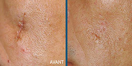 avant aprés laser fraxel 2
