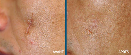 avant aprés laser fraxel 2