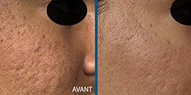 avant aprés laser fraxel 4