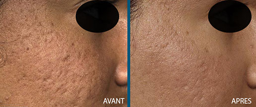 avant aprés laser fraxel 4