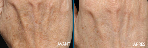 avant après pigmentations 1