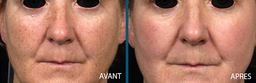 avant après pigmentations 2