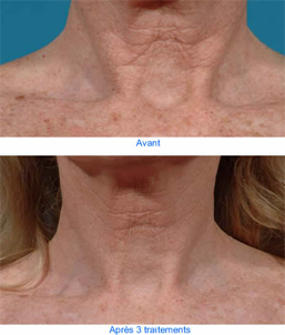 Enlever les taches au laser sur le décolleté.