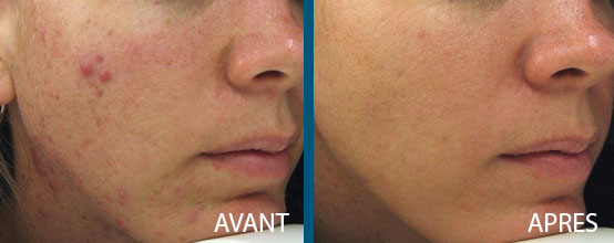 avant après laser fraxel repair 11