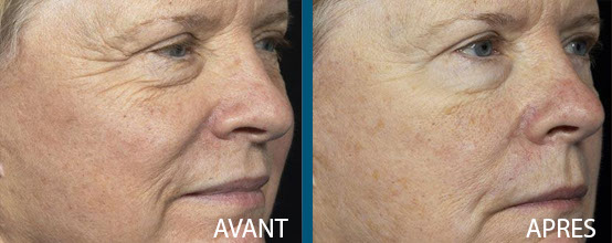 avant après laser fraxel repair 13