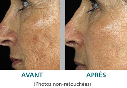 Contour des yeux: rajeunir le regard et gommer les rides avec le laser Fraxel Dual à Paris.