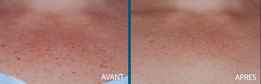 avant après pigmentations