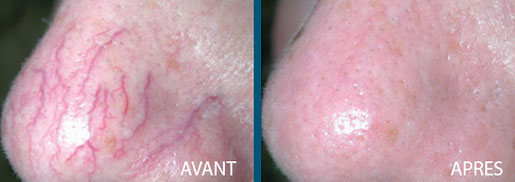 avant après vasculaire 3
