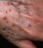 taches brune sur la main taches de soleil mains abimées