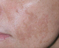 traiter le melasma masque de grossesse laser fraxel dual tache visage