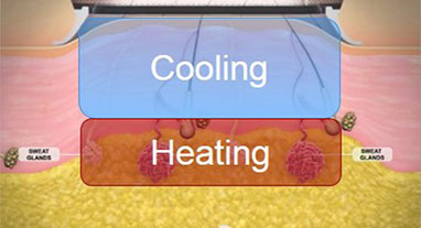 Miradry: traitement médical de la transpiration des aisselles à Paris et en France.