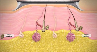 MiraDry: traitements de la transpiration des aisselles à Paris et en France, de l'hyperhydrose axillaire.