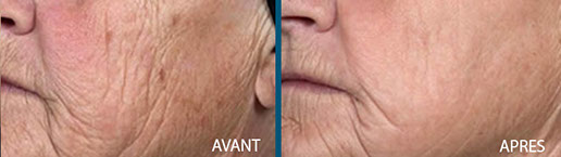 avant après rajeunissement