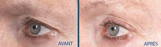 avant après rajeunissement 1