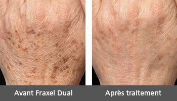 Résultats du rajeunissement des mains au laser à Paris 