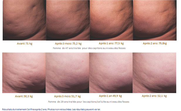 CELLFINA avis: Avant et après.