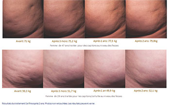 CELLFINA avis: Avant et après.