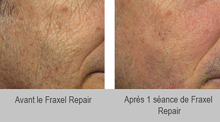 Rajeunissement sans chirurgie au laser pour les homme à Paris: médecins esthétique et dermatologie esthétique anti-rides.