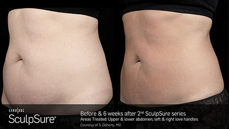Mincir sans chirurgie avec sculpsure et la cryolipolyse