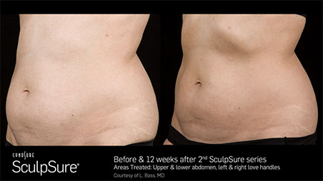Sculpsure avis et résultats paris