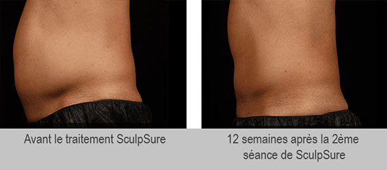 Traitement sculpsure avis et résultats sur les hommes à paris