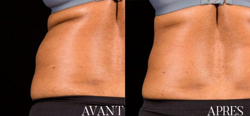 Résultats avant et après deux séances de laser sculpsure 