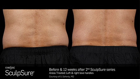 Silhouette: sculpsure et cryolipolyse à Paris