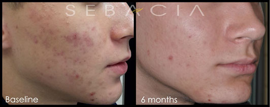 sebacia traitement durable contre l'acné