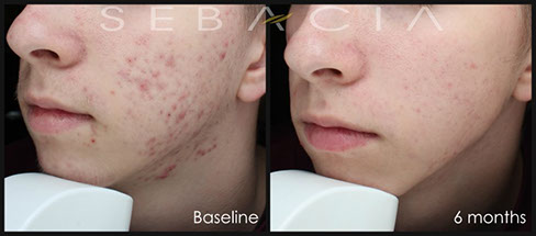 Résultats du traitement contre l'acné sebacia au laser à paris